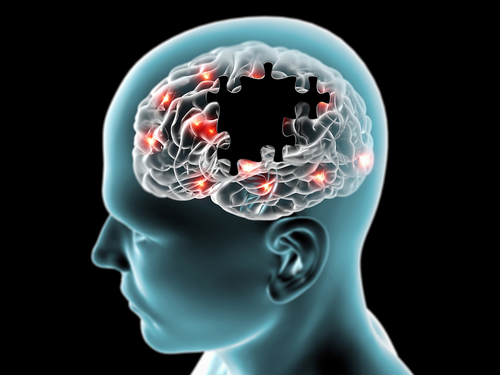 Alzheimer, Beckman Coulter Diagnostics amplia il portafoglio dei biomarcatori ematici