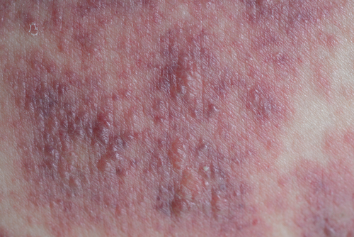 La teledermatologia migliora la qualità di vita quanto le visite in presenza nei pazienti con dermatite atopica