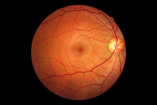 Nell’occlusione venosa retinica è possibile un’alterazione dell’equilibrio redox tiolo-disolfuro