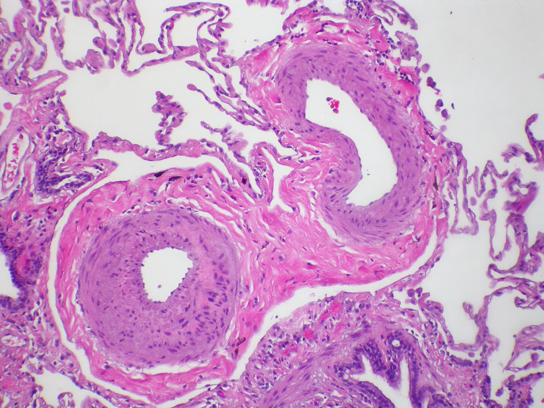 Ruolo della PlGF nel rimodellamento vascolare dell’ipertensione arteriosa polmonare