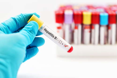 Elevata prevalenza di epatite B nelle persone con HIV, il trend 2018-2024