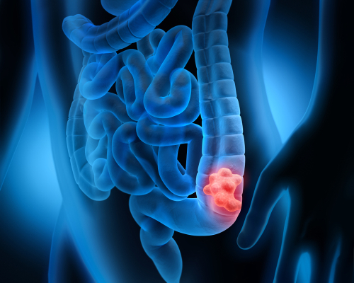 mCRC multiorgano: il debulking aggiunto alla chemioterapia non migliora la sopravvivenza