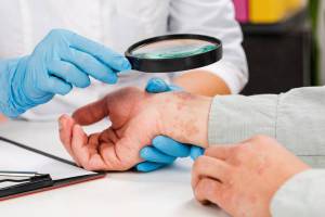 Entesite subclinica in pazienti con psoriasi come fattore predittivo di artrite psoriasica