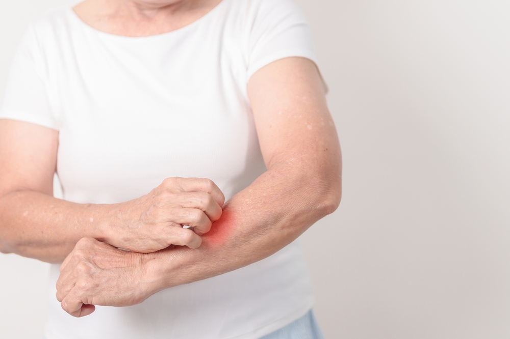 Lupus eritematoso sistemico: in Italia 23mila pazienti, nasce registro LUNET