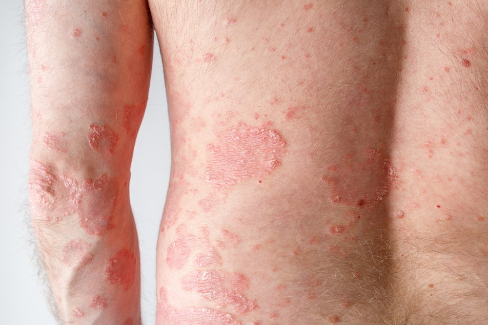 Psoriasi, proteina chiave alimenta infiammazione: la nuova scoperta apre la strada a terapie innovative
