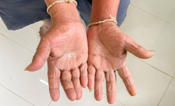Giornata mondiale della Sclerodermia, APMARR: “La multidisciplinarietà deve diventare un diritto”