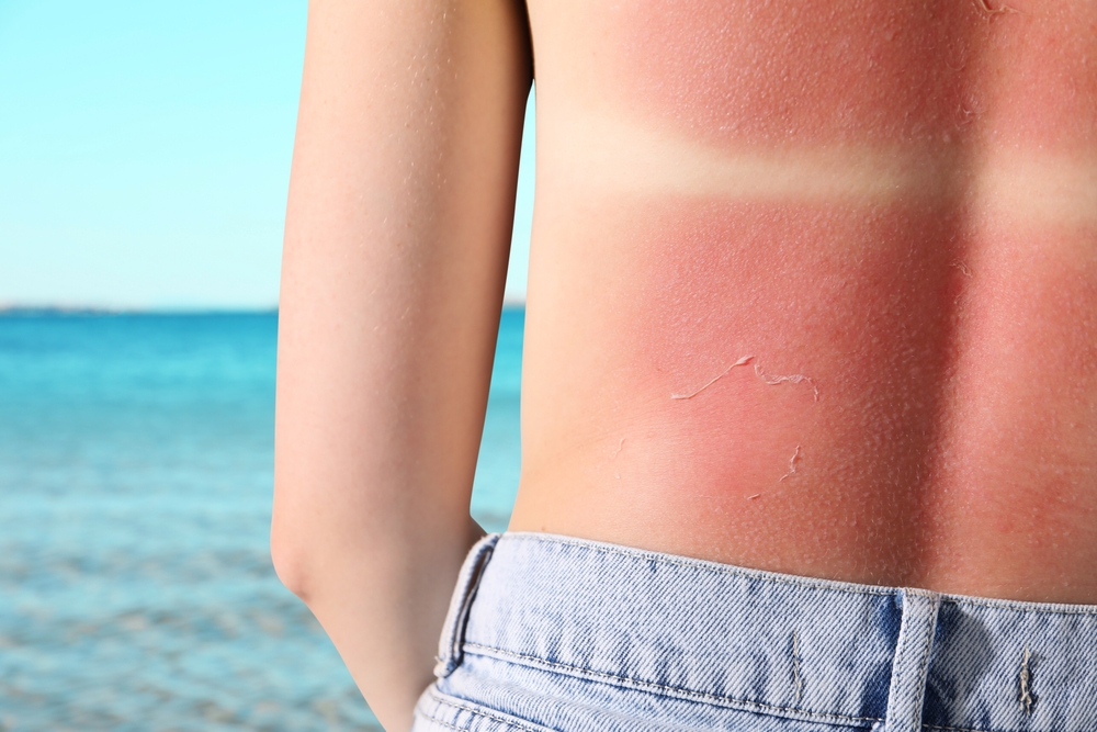 Vacanze estive senza rischi: le 5 insidie per la salute da conoscere prima di partire