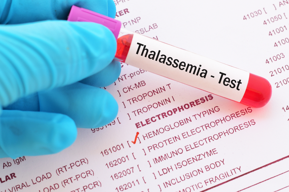 Beta-talassemia, nuova terapia genica al via: 9 pazienti verso l’indipendenza dalle trasfusioni