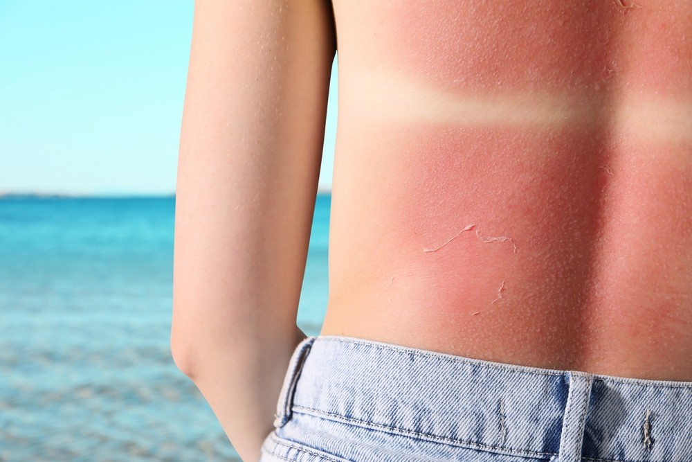 Sole e melanoma. Iss: “No a fake news sulle creme, fidarsi della scienza”