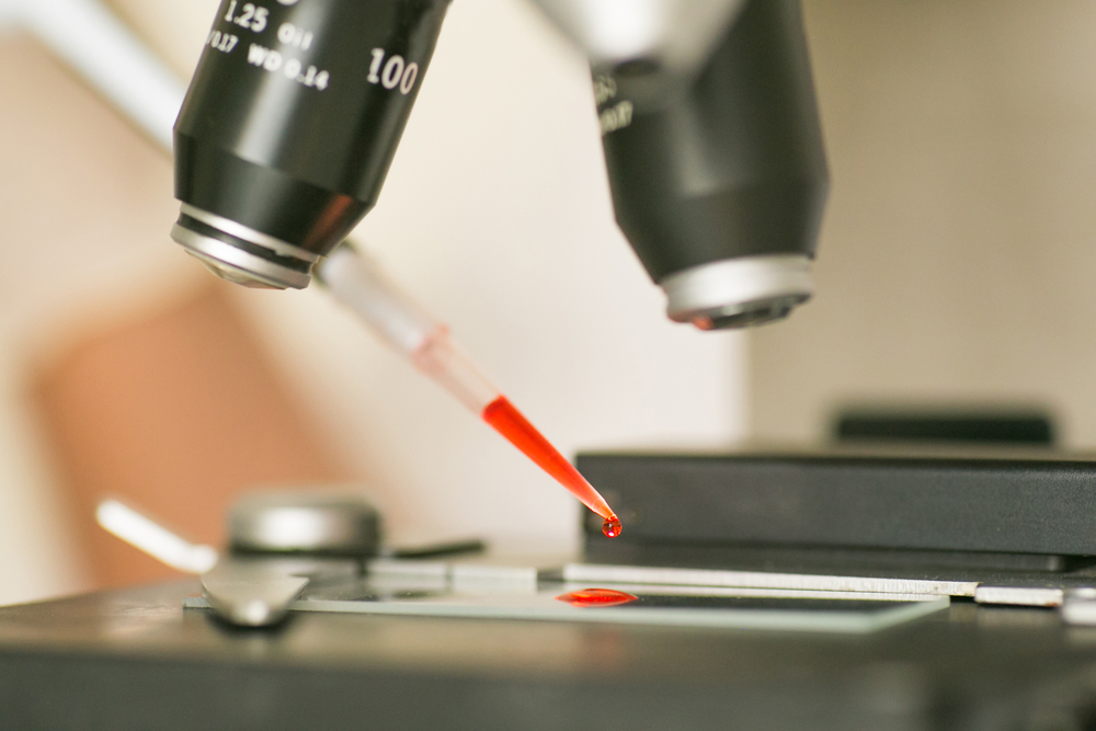Microplastiche nel sangue: presenti nell’84% dei pazienti colpiti da infarto