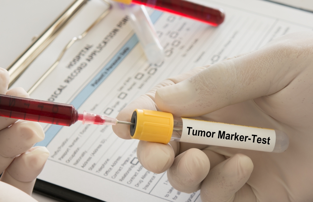 Screening oncologici, 7,6 milioni di italiani esclusi: oltre 50 mila tumori non intercettati