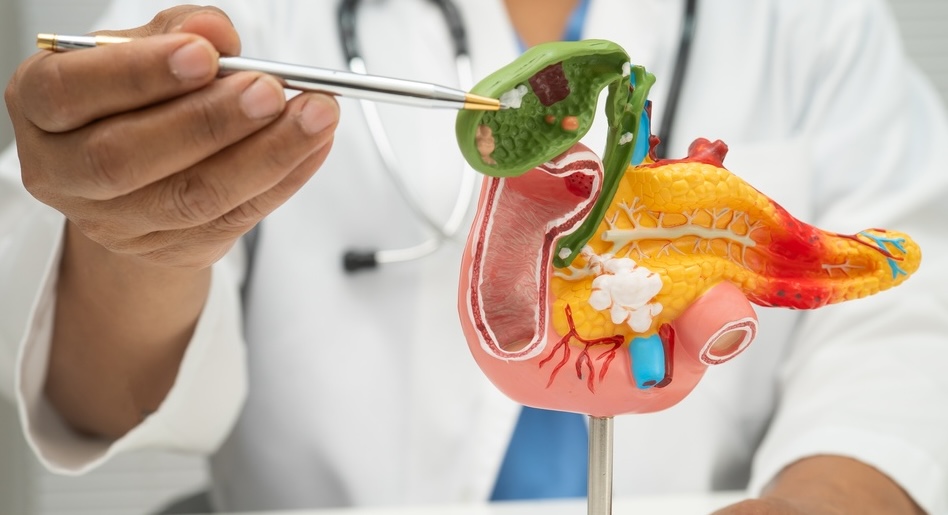 Tumore del pancreas metastatico. Ema avvia la revisione accelerata di daraxonrasib: possibile iter più rapido verso l’autorizzazione