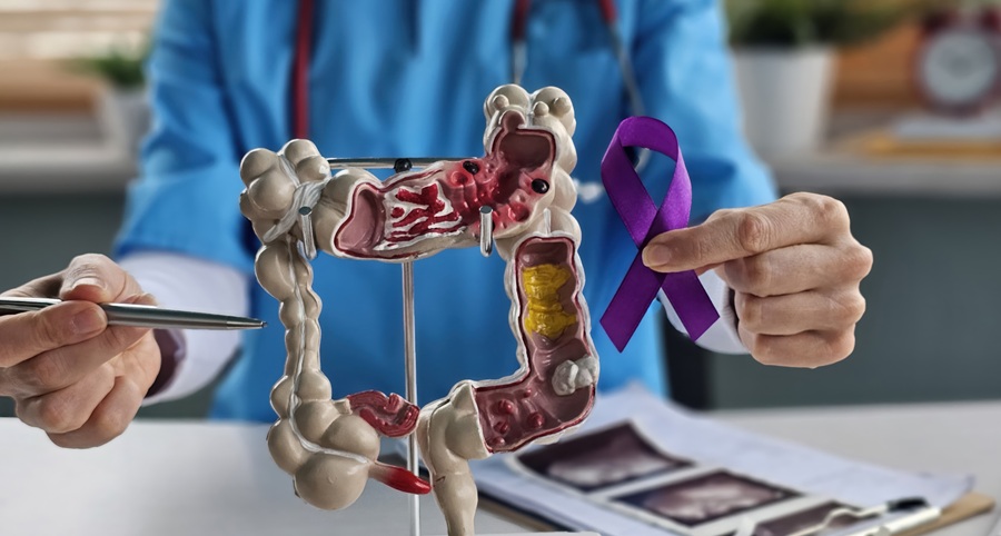 Tumore del colon-retto, i sintomi che i giovani adulti non dovrebbero sottovalutare