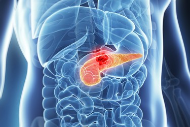 Carcinoma pancreatico a insorgenza precoce: casi globali in aumento del 72,6%